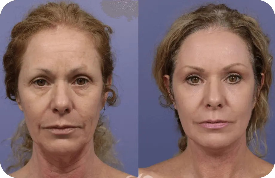 Synevra before and after results showing visibly smoother, firmer, more radiant skin